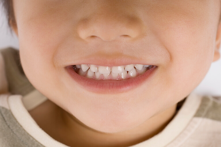 歯並びとむし歯の関係